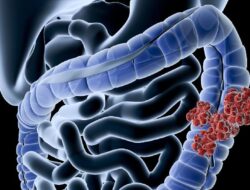 Gen Z Banyak Kena Kanker Usus Besar, Makanan Ini Jadi Biang Keroknya