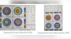 Kisah Pria 26 Tahun di Bandung Berjuang Lawan Keratoconus dan Butuh Donor Kornea